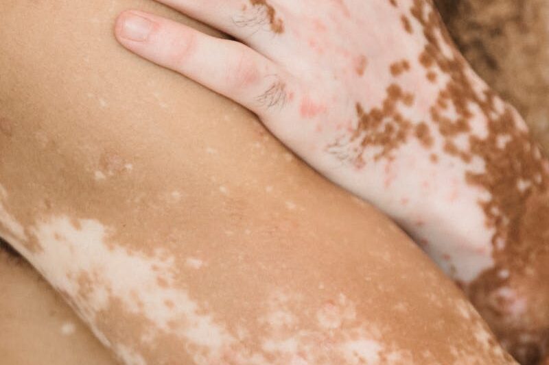 Body of unrecognizable male with naked torso and loss of skin color with white patches standing with hand on shoulder