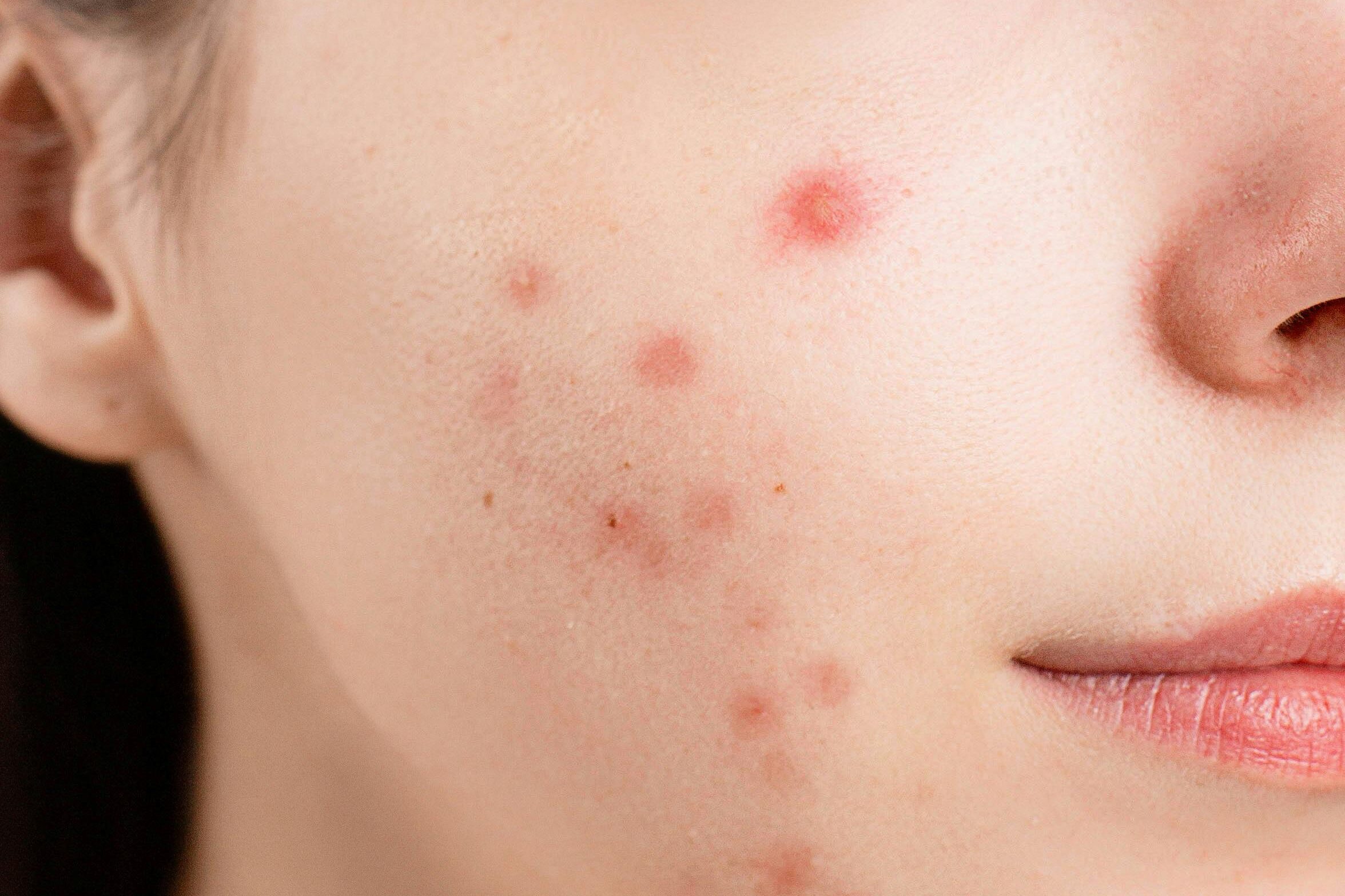 A detailed close-up of a woman's face showing acne blemishes on her skin.